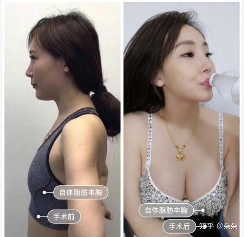 用自己脂肪丰胸视频,揭秘自体脂肪填充美胸全过程